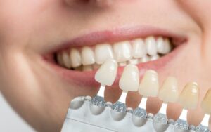 your dental veneers